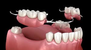 Dental implant