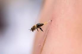 Bee sting